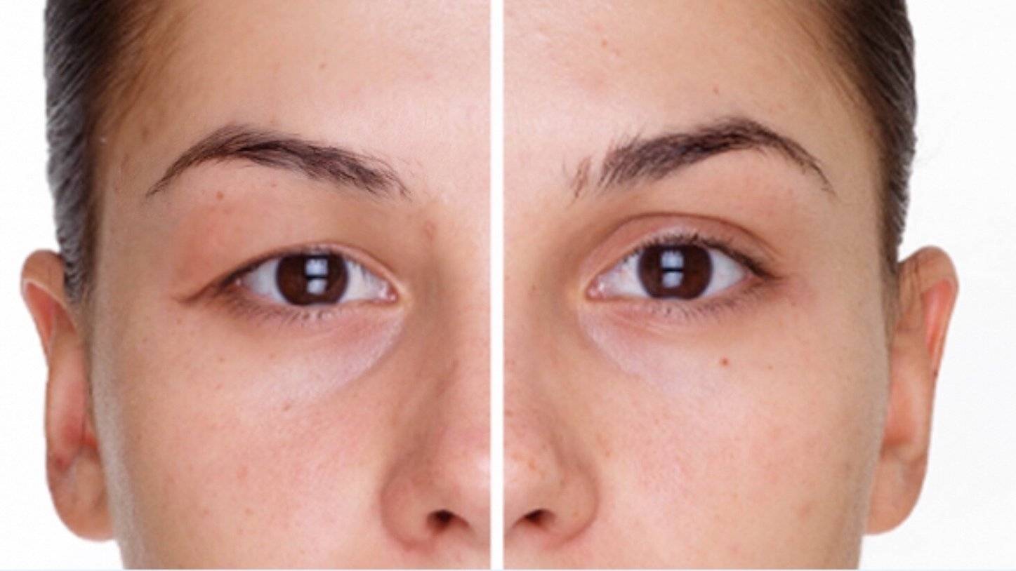 dr akyol goz kapaklarindaki sarkmalar gorme guclugune yol acabiliyor aAASndVV